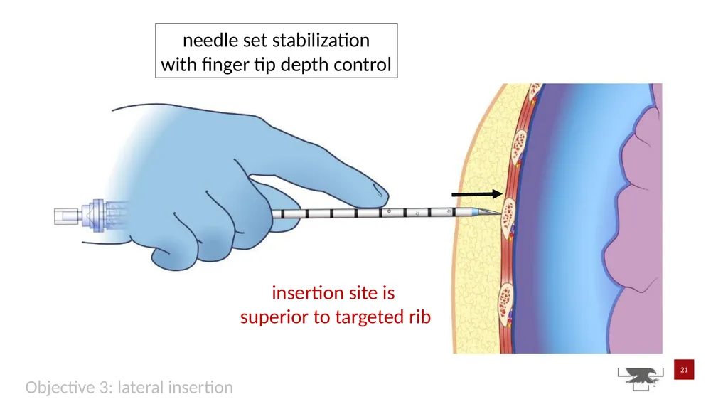 S P E A R™ decompression needle system Simplified - slide 21 of 36