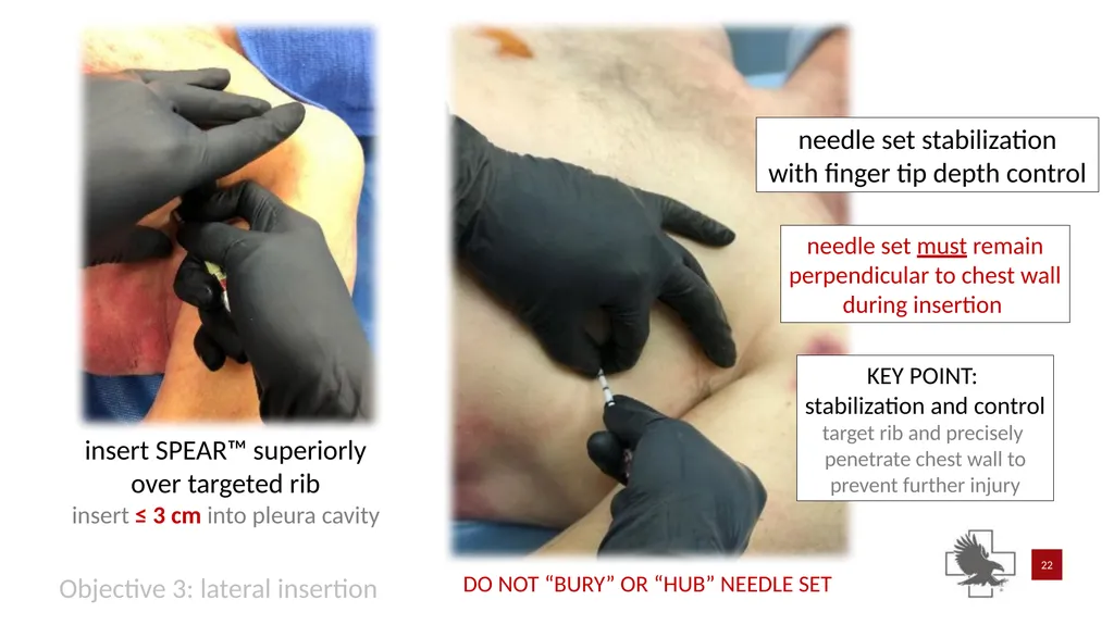 S P E A R™ decompression needle system Simplified - slide 22 of 36