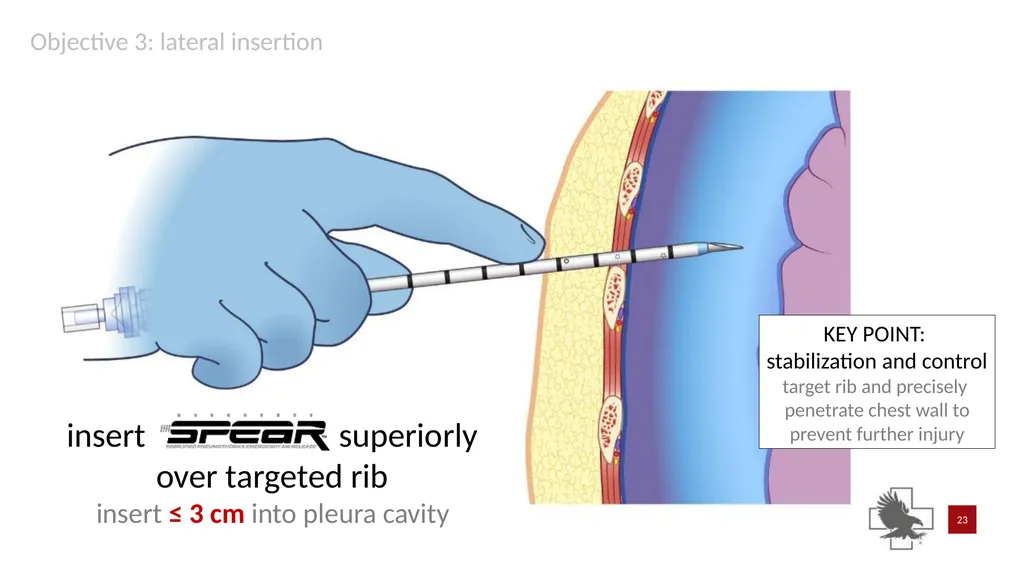 S P E A R™ decompression needle system Simplified - slide 23 of 36