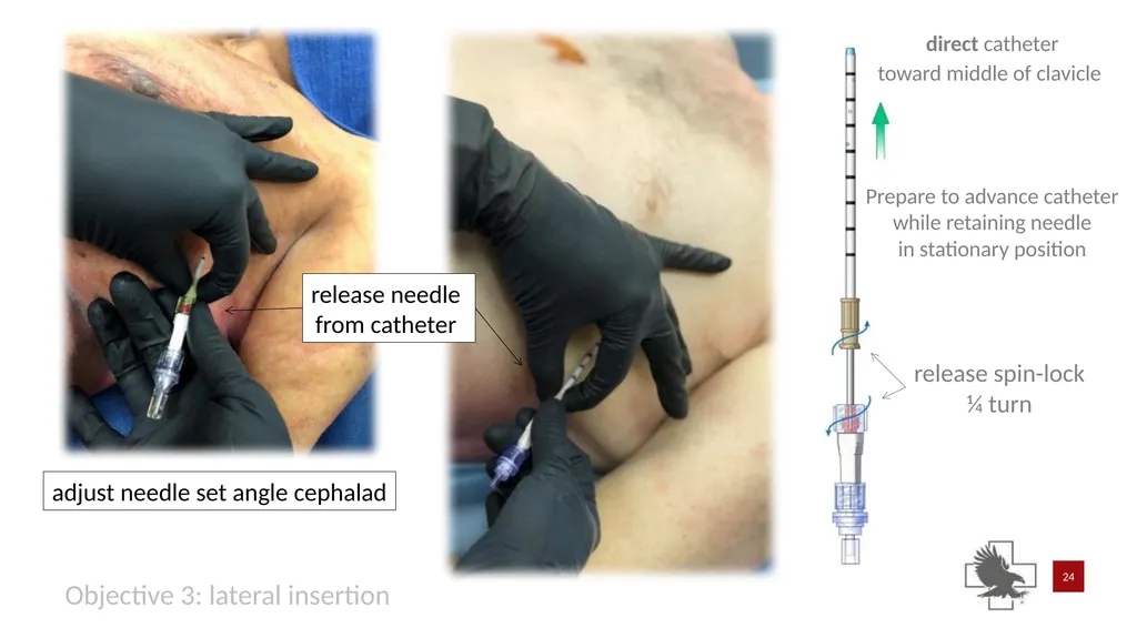 S P E A R™ decompression needle system Simplified - slide 24 of 36