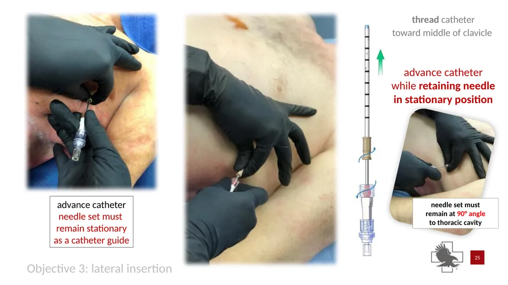 S P E A R™ decompression needle system Simplified - slide 25 of 36