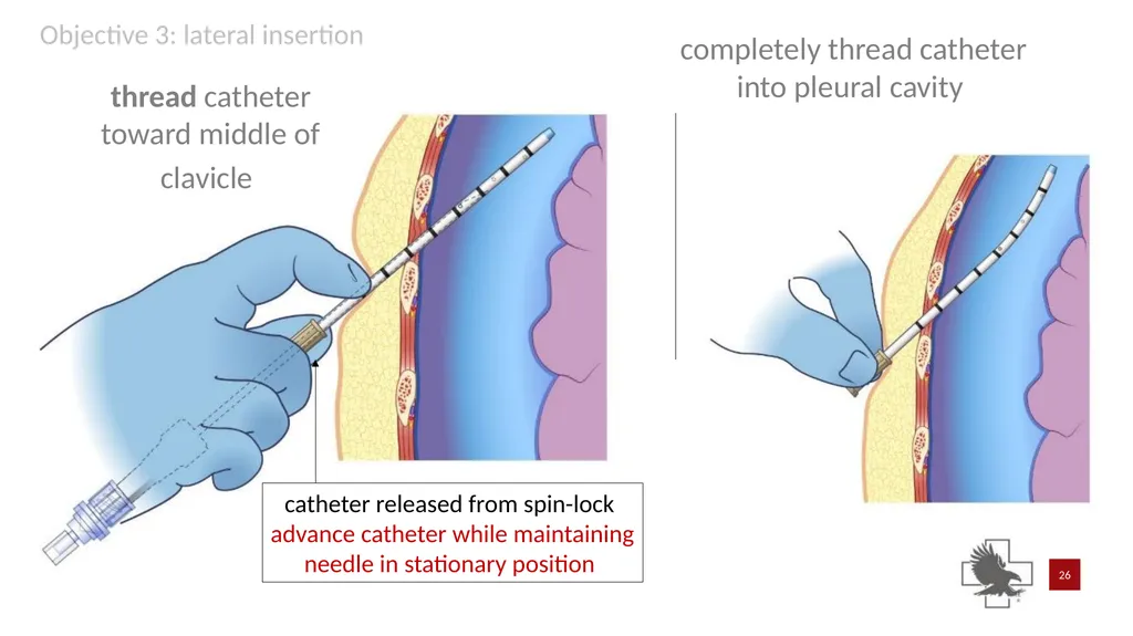 S P E A R™ decompression needle system Simplified - slide 26 of 36