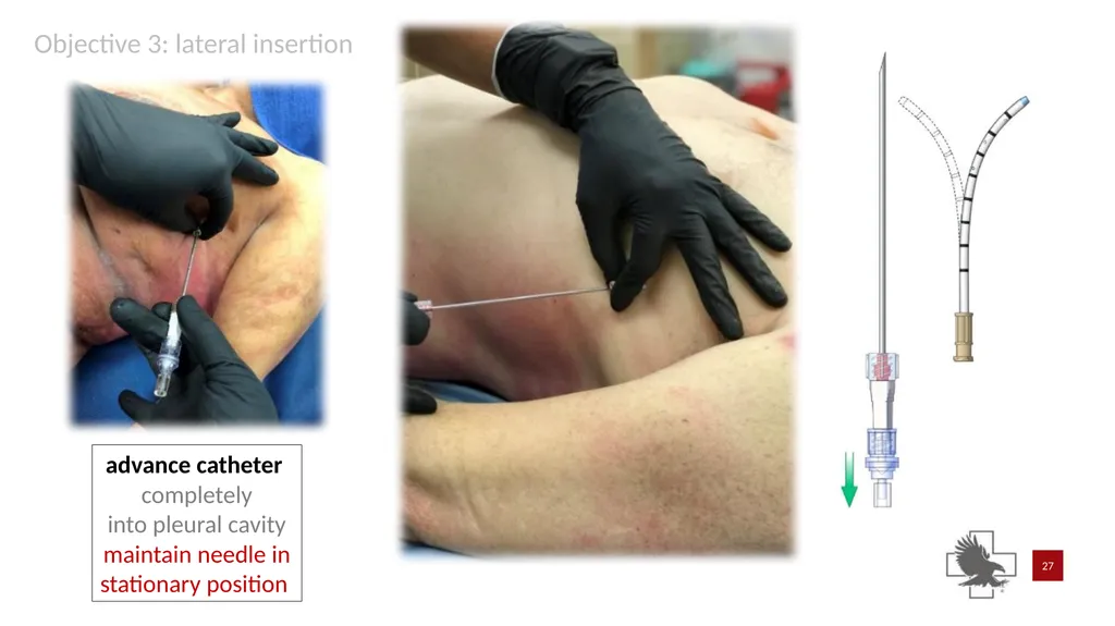 S P E A R™ decompression needle system Simplified - slide 27 of 36
