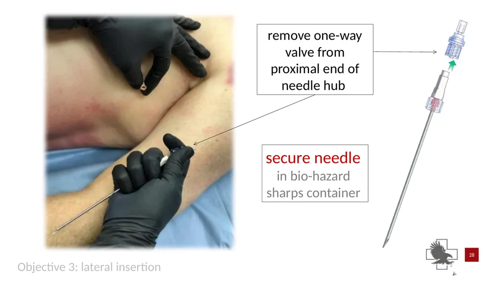 S P E A R™ decompression needle system Simplified - slide 28 of 36