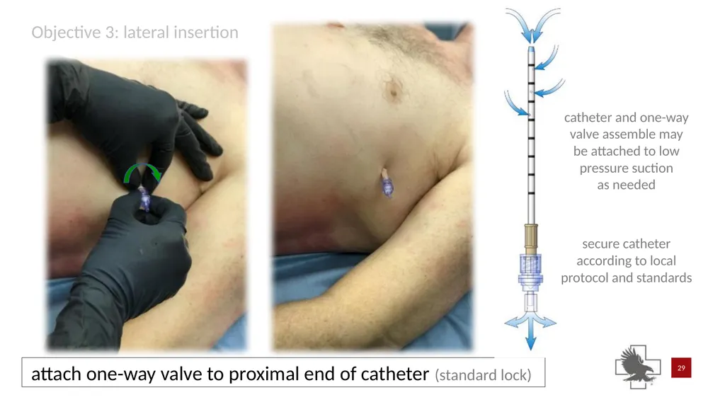 S P E A R™ decompression needle system Simplified - slide 29 of 36