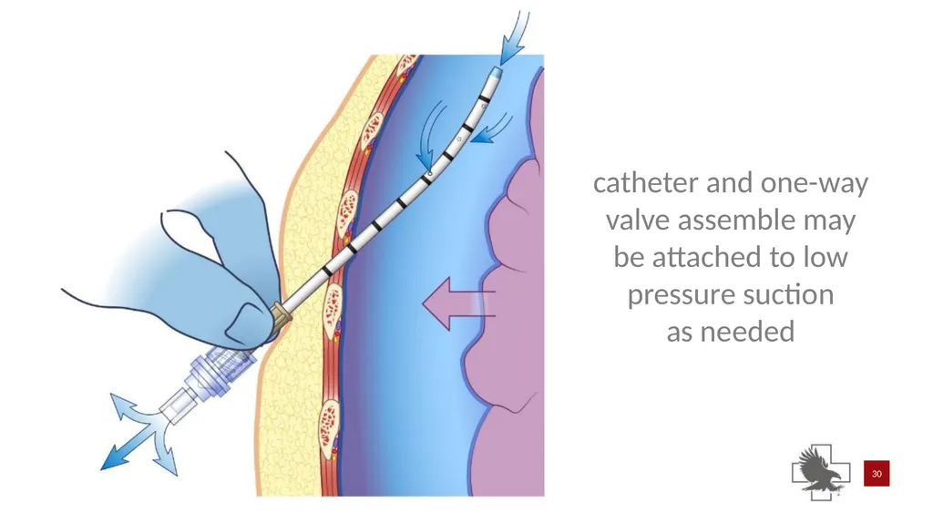 S P E A R™ decompression needle system Simplified - slide 30 of 36