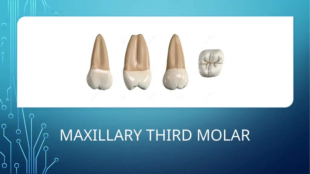 The permanent maxillary molars Dr. pinar khalis - slide 43 of 50