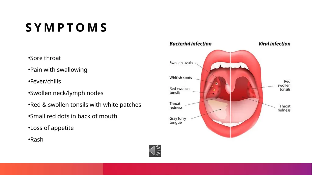 Strep Throat What it is Strep throat is caused by - slide 3 of 6