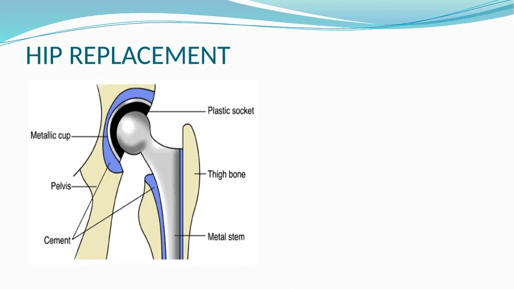 1 Subject : Orthopedic and Neurovascular Nursing - slide 22 of 61