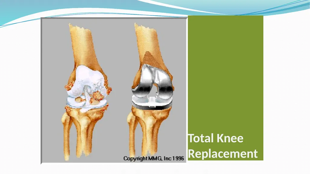 1 Subject : Orthopedic and Neurovascular Nursing - slide 23 of 61