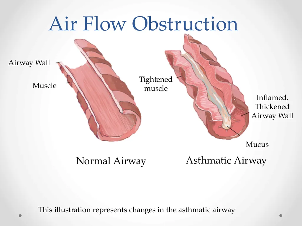 Status Asthmaticus in the Pediatric Emergency - slide 7 of 66