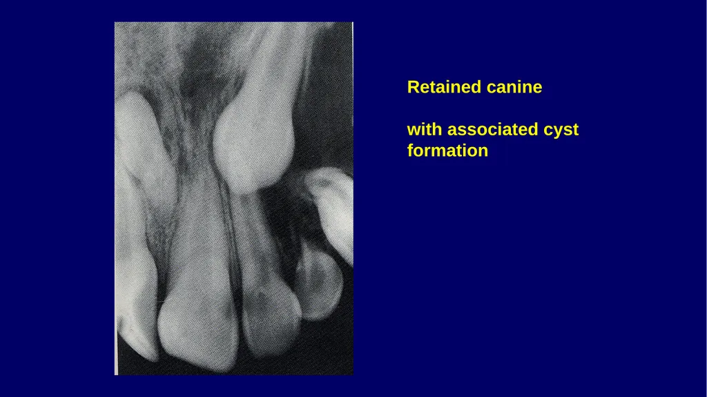 Impacted canines • Maxillary canines more commonly - slide 19 of 63