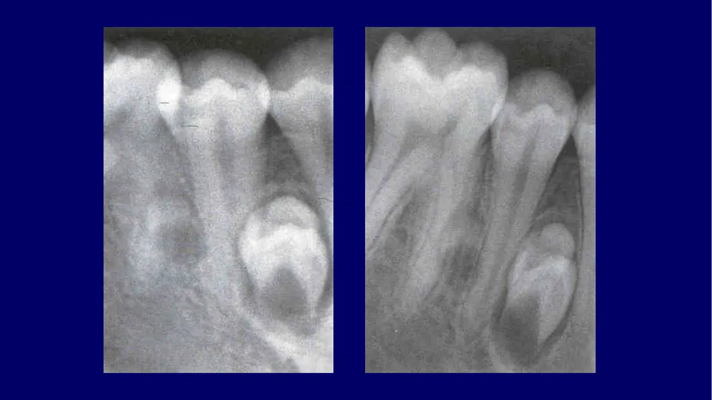 Impacted canines • Maxillary canines more commonly - slide 13 of 63