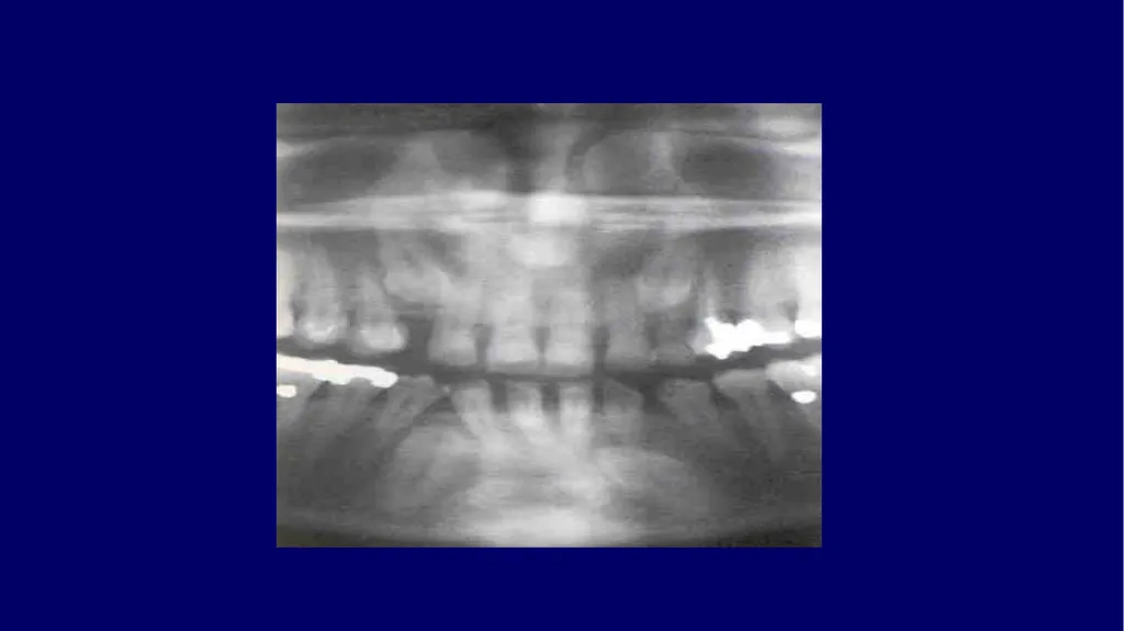Impacted canines • Maxillary canines more commonly - slide 14 of 63