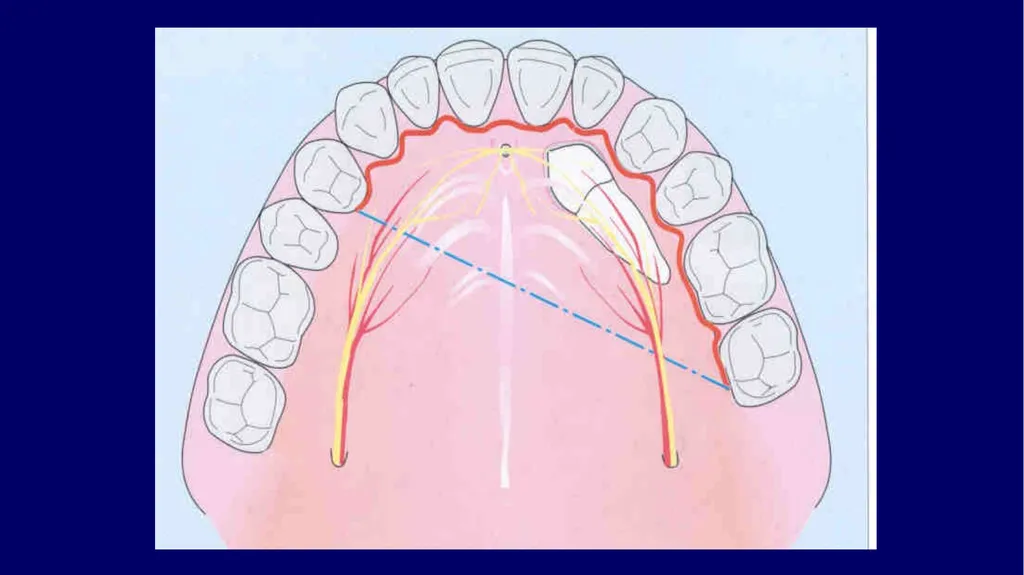 Impacted canines • Maxillary canines more commonly - slide 15 of 63