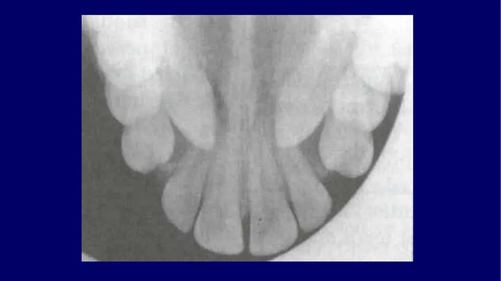 Impacted canines • Maxillary canines more commonly - slide 16 of 63