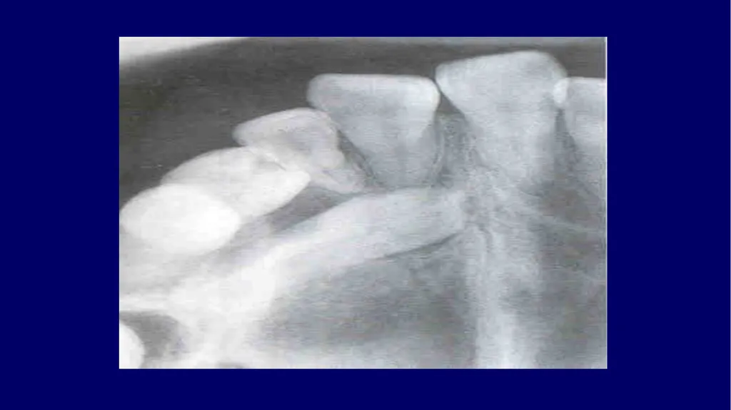 Impacted canines • Maxillary canines more commonly - slide 17 of 63