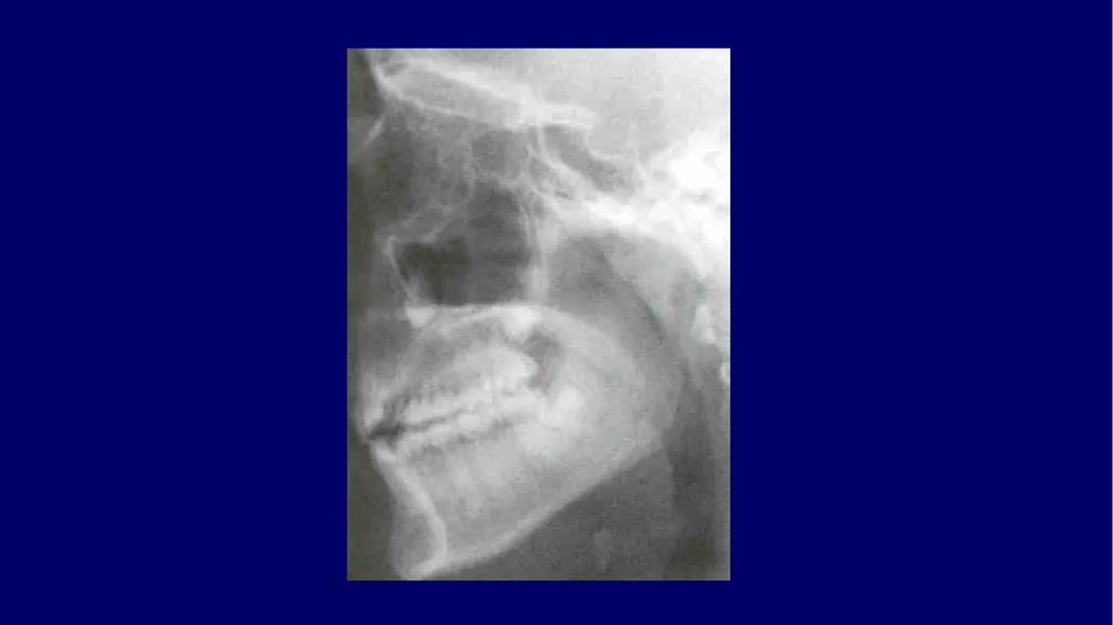 Impacted canines • Maxillary canines more commonly - slide 18 of 63