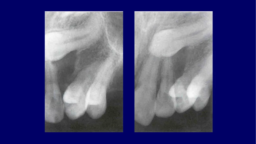 Impacted canines • Maxillary canines more commonly - slide 20 of 63