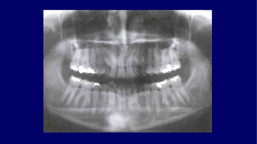 Impacted canines • Maxillary canines more commonly - slide 21 of 63