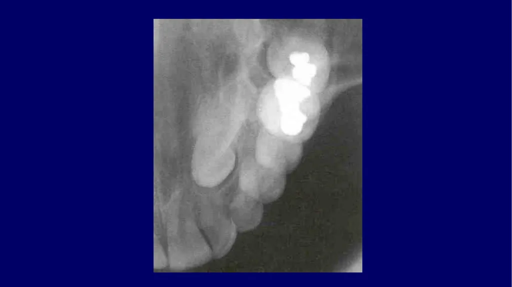 Impacted canines • Maxillary canines more commonly - slide 22 of 63