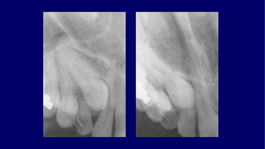 Impacted canines • Maxillary canines more commonly - slide 23 of 63