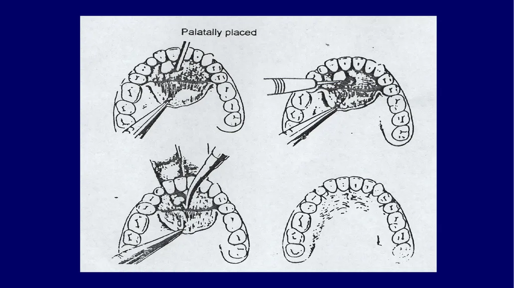 Impacted canines • Maxillary canines more commonly - slide 24 of 63