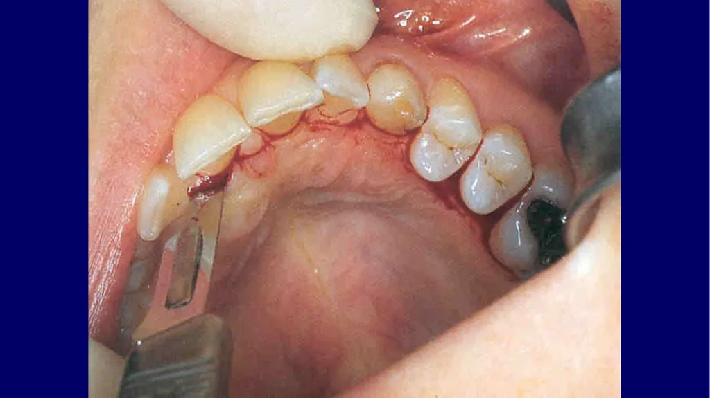 Impacted canines • Maxillary canines more commonly - slide 25 of 63