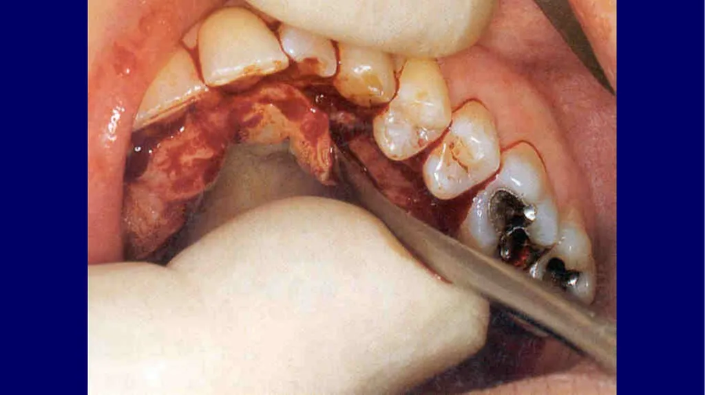 Impacted canines • Maxillary canines more commonly - slide 26 of 63