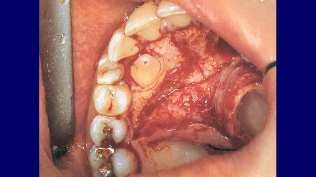 Impacted canines • Maxillary canines more commonly - slide 27 of 63