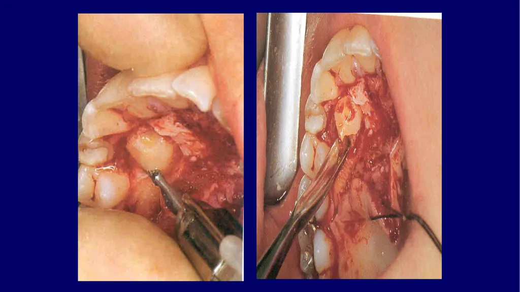 Impacted canines • Maxillary canines more commonly - slide 28 of 63