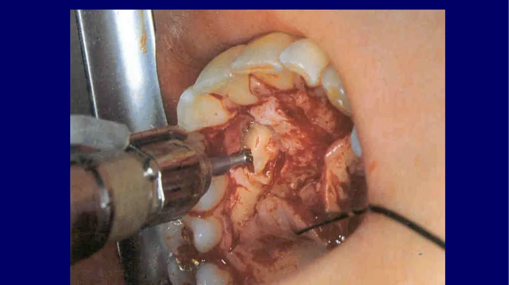 Impacted canines • Maxillary canines more commonly - slide 29 of 63