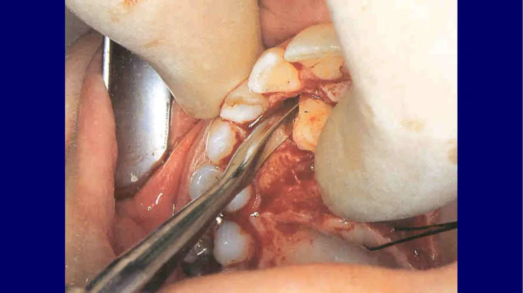 Impacted canines • Maxillary canines more commonly - slide 30 of 63