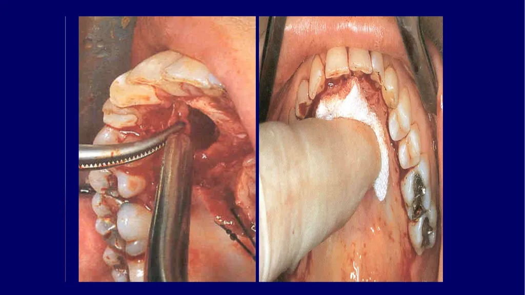 Impacted canines • Maxillary canines more commonly - slide 31 of 63