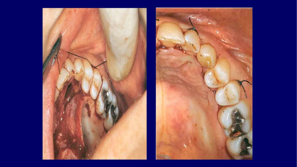 Impacted canines • Maxillary canines more commonly - slide 32 of 63