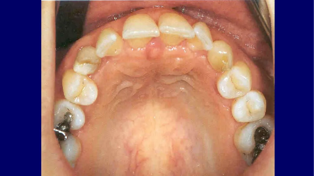 Impacted canines • Maxillary canines more commonly - slide 33 of 63