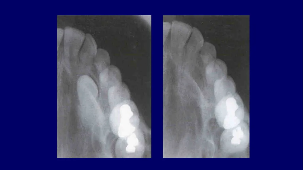 Impacted canines • Maxillary canines more commonly - slide 34 of 63