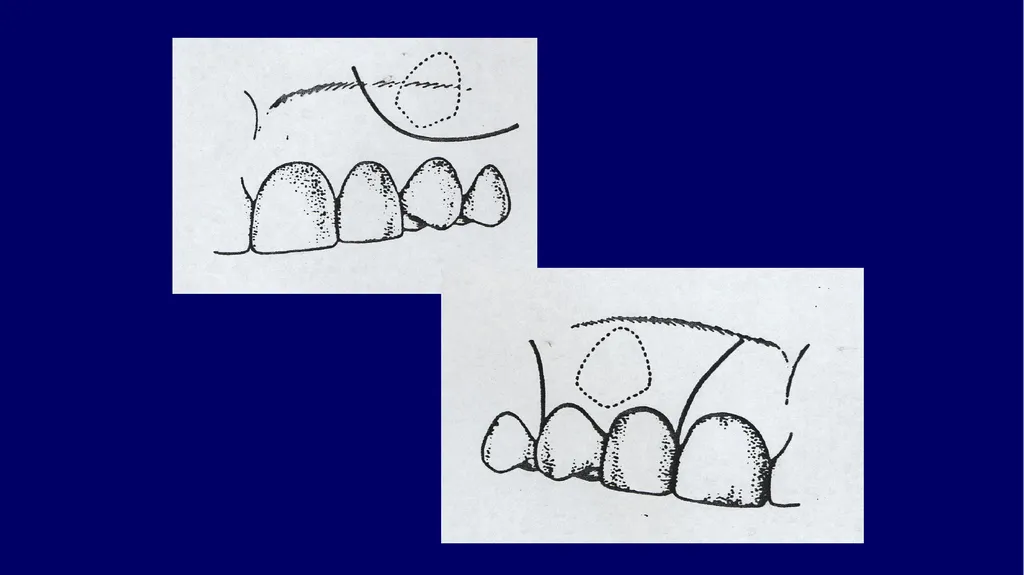 Impacted canines • Maxillary canines more commonly - slide 35 of 63