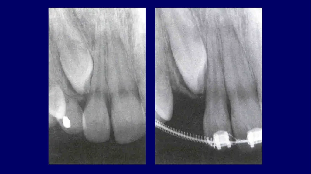 Impacted canines • Maxillary canines more commonly - slide 36 of 63