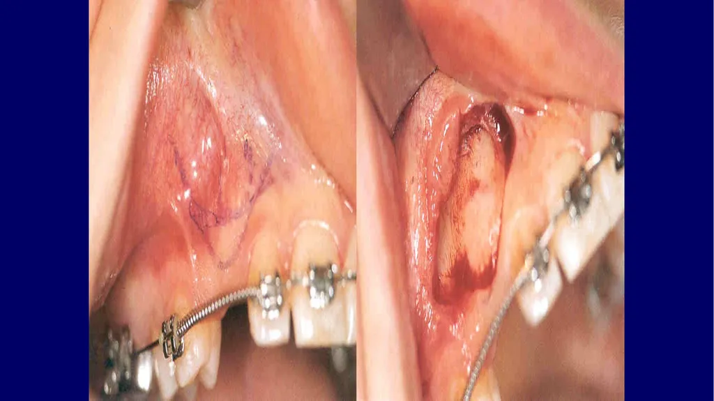 Impacted canines • Maxillary canines more commonly - slide 37 of 63