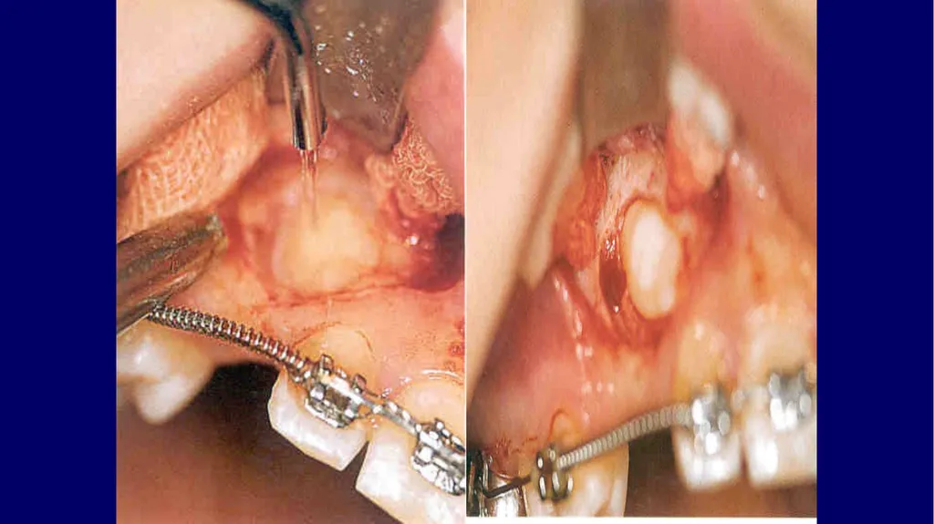 Impacted canines • Maxillary canines more commonly - slide 38 of 63