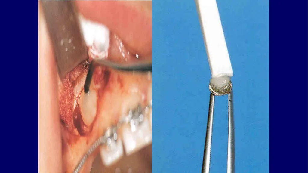 Impacted canines • Maxillary canines more commonly - slide 39 of 63