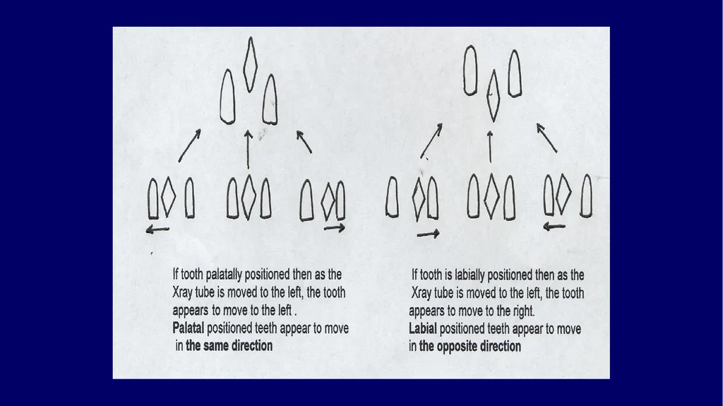 Impacted canines • Maxillary canines more commonly - slide 4 of 63