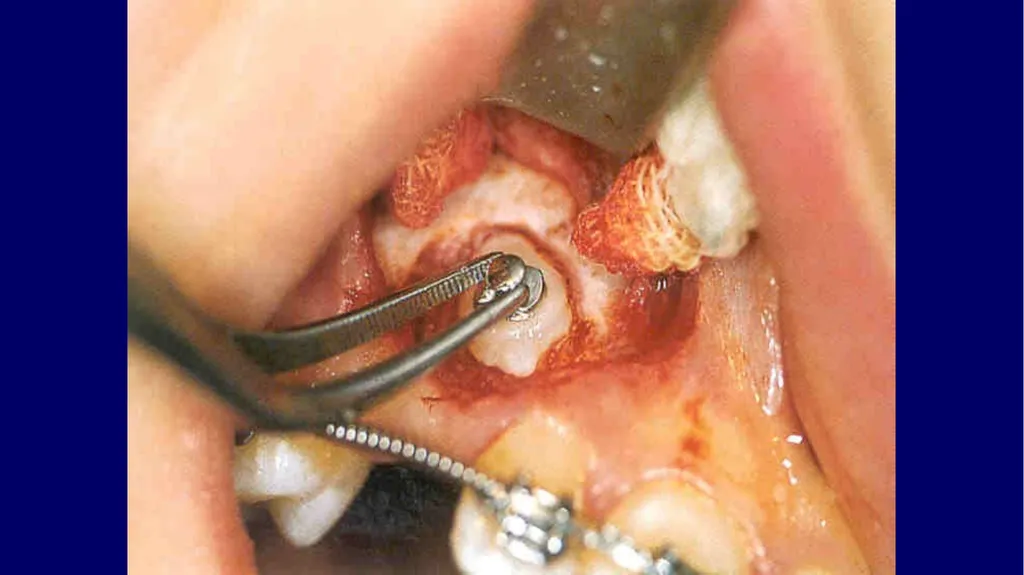 Impacted canines • Maxillary canines more commonly - slide 40 of 63