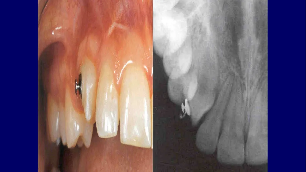 Impacted canines • Maxillary canines more commonly - slide 41 of 63