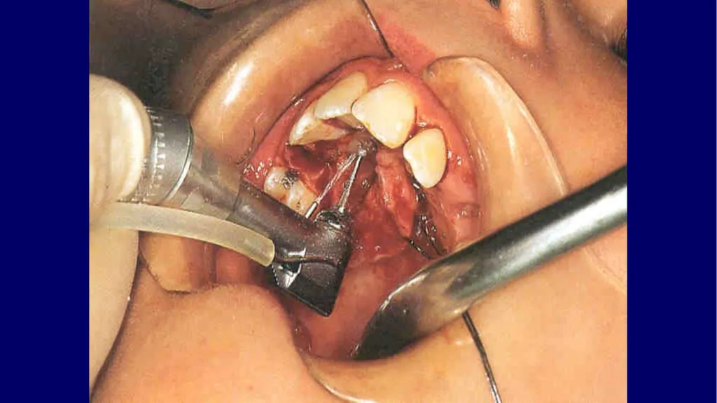 Impacted canines • Maxillary canines more commonly - slide 42 of 63