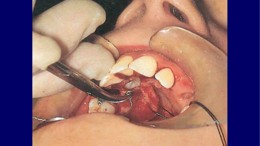 Impacted canines • Maxillary canines more commonly - slide 43 of 63