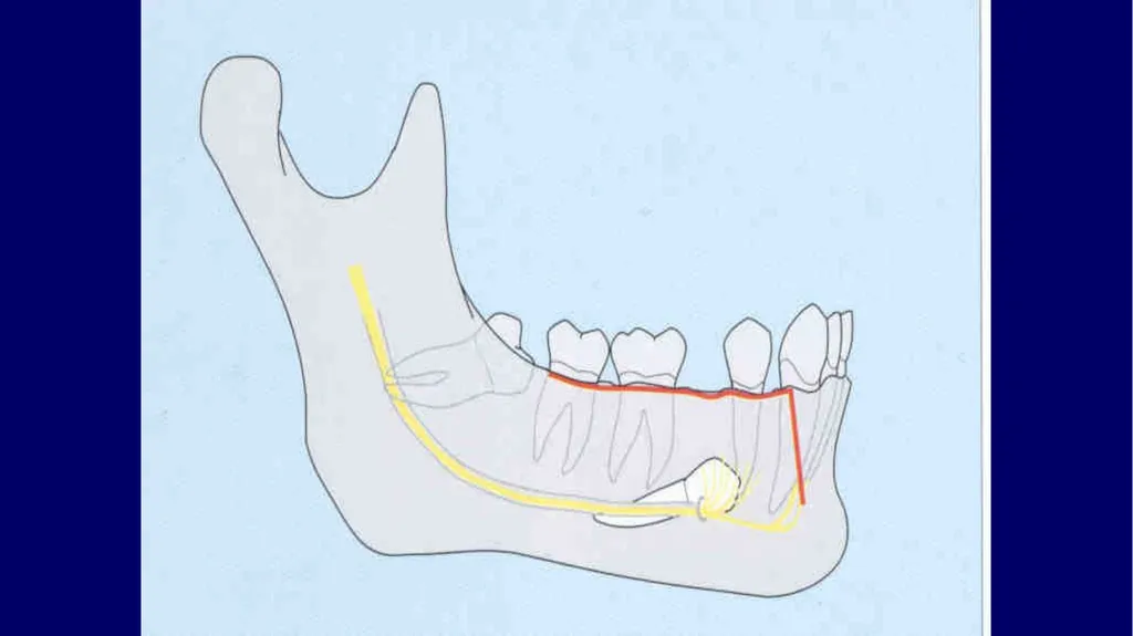 Impacted canines • Maxillary canines more commonly - slide 44 of 63