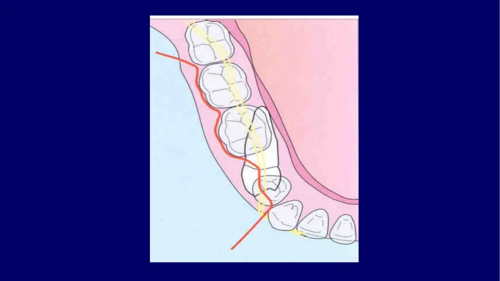 Impacted canines • Maxillary canines more commonly - slide 45 of 63