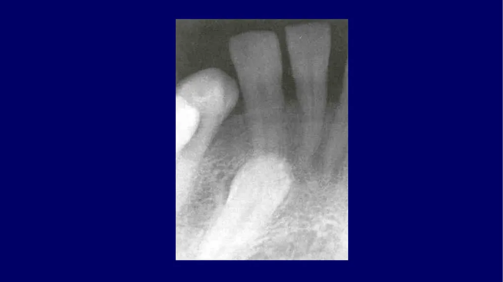 Impacted canines • Maxillary canines more commonly - slide 46 of 63